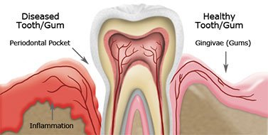 Gum Disease Treatment