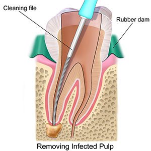 Root Canals